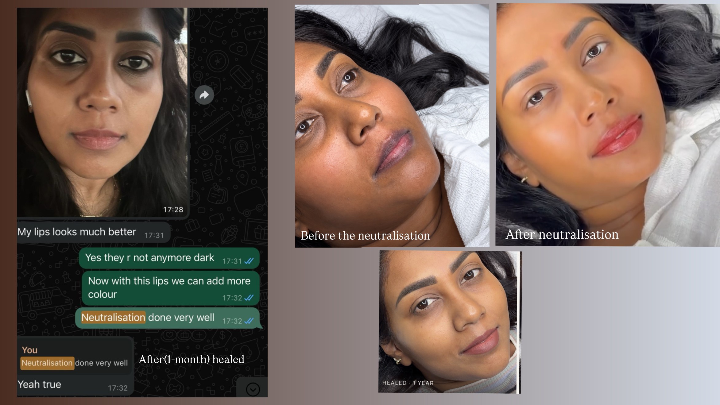 Dark lip neutralisation case — before, after, healed 1 year